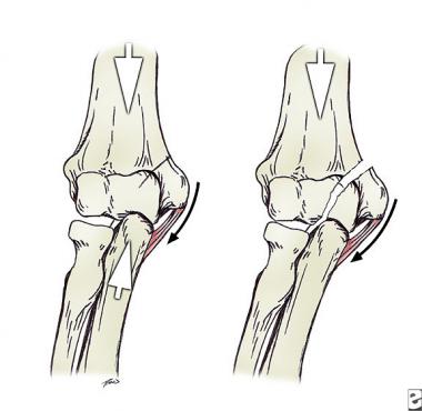 Valgus levering force creating fracture. 