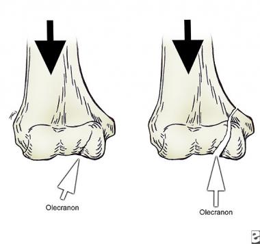 Olecranon acting as a wedge and creating medial co