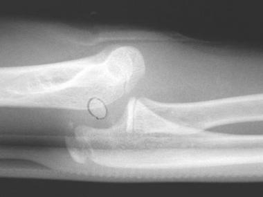 Elbow dislocation associated with medial epicondyl