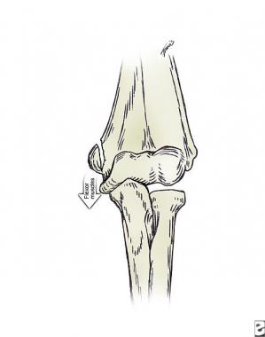 Epicondyle fractures can be caused by traction for