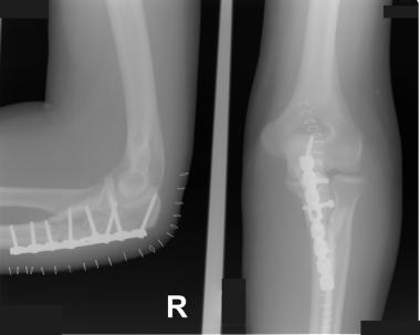 Bado type II lesion after open reduction and inter