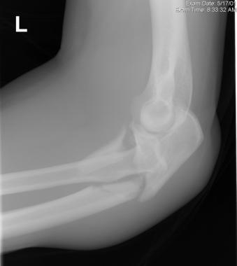 Bado type II lesion. 