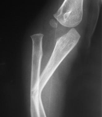 Bado type III lesion with lateral displacement of 