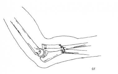 Bado type IV lesion. 