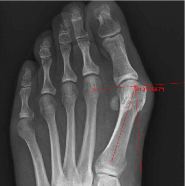 Distal metatarsal articular angle (normal &lt; 10°