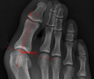 Proximal phalanx articular angle (normal &lt; 10°)