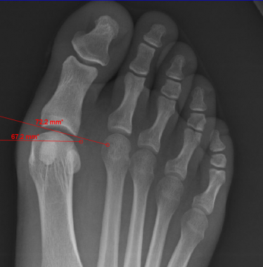 Metatarsophalangeal joint congruence. 