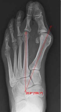 Intermetatarsal angle (normal &lt; 9°). 