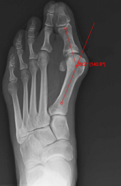 Hallux valgus angle (normal &lt; 15°). 