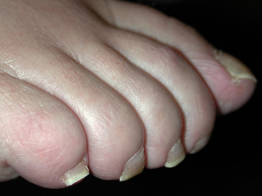 Claw toe. Mallet toes 3 and 4. 