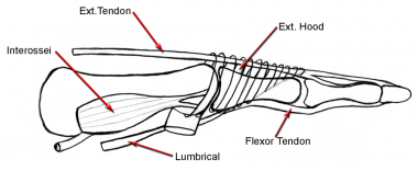 Claw toe. Extensor tendon connecting with extensor