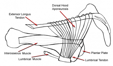 Claw toe. Plantar plate stretches out, and proxima