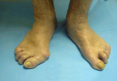 Rheumatoid arthritis. Note greater deformity of ri