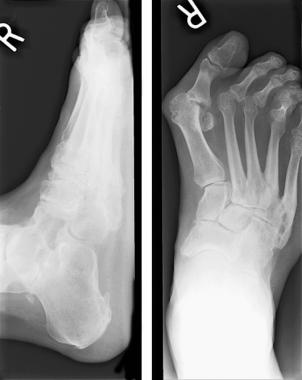 Rheumatoid arthritis. Note lateral deviation of ha