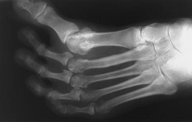 Anteroposterior radiograph of foot depicts idiopat