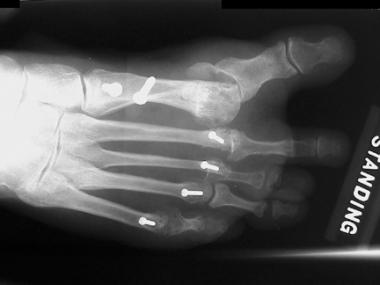 Anteroposterior radiograph of foot shows iatrogeni