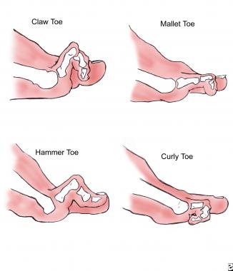 Diagram comparing clinical appearances of lesser-t