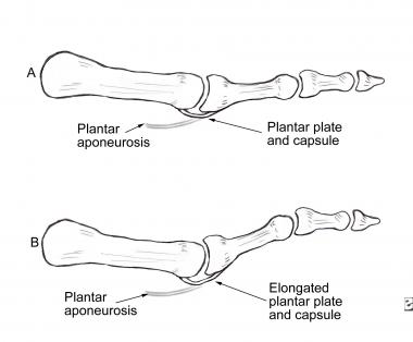 Pathomechanics of hammertoe deformity. Elongated p