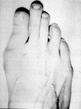 Morton foot, wherein second ray (metatarsal and co