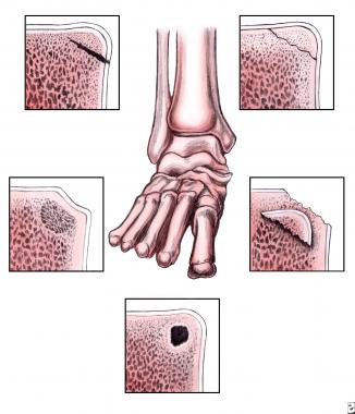 Osteochondral lesions of the talus. Modified stagi