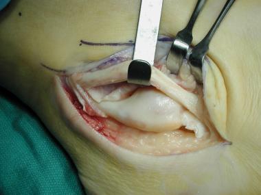 Peroneus longus tendon next to peroneus brevis ten