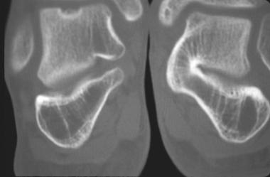 CT scan appearance of talocalcaneal coalition. 