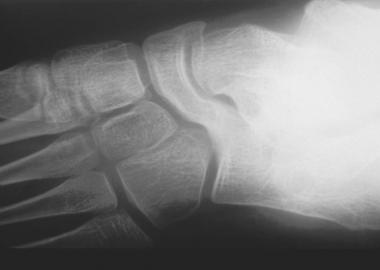 Plain radiograph (Slomann view) showing typical ap