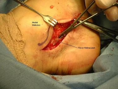 Surgical approach for release of the flexor retina