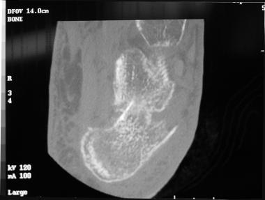 CT scan of calcaneal fracture shows prominent late