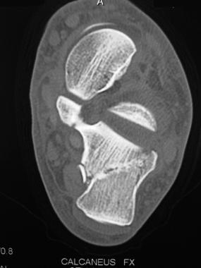 Relatively mild calcaneal fracture still exhibitin