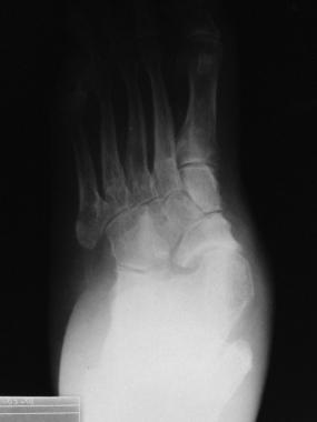 Valgus foot deformity with medial dislocation of t