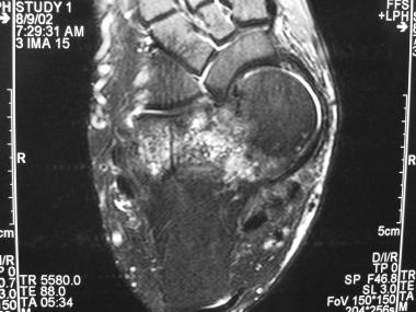 Valgus foot deformity with medial dislocation of t