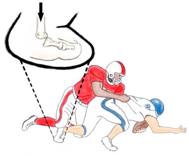 Typical mechanism of turf toe injury. Foot is fixe