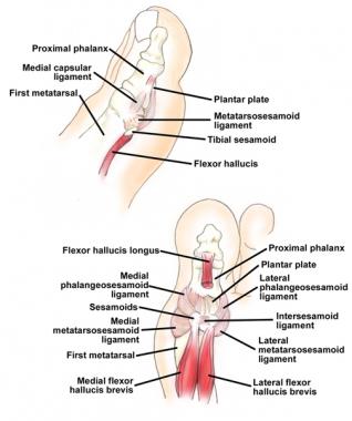 Capsuloligamentous-sesamoid complex of hallux. Top
