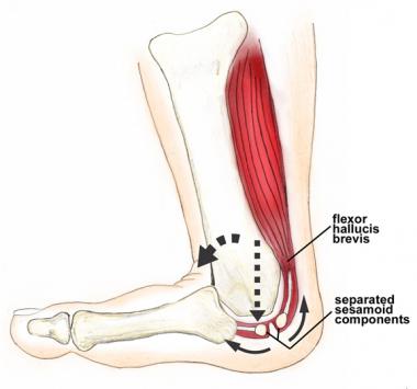 Metatarsophalangeal (MTP) joint hyperextension wit