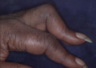 Boutonnière deformity. Image courtesy of David Boz