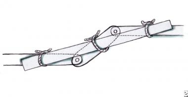 The scaphoid acts like a bridge between the proxim