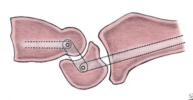 The wrist is a simple link between the proximal an