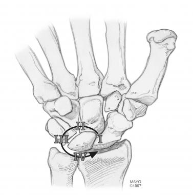 Mayfield perilunate instability pattern. Copyright