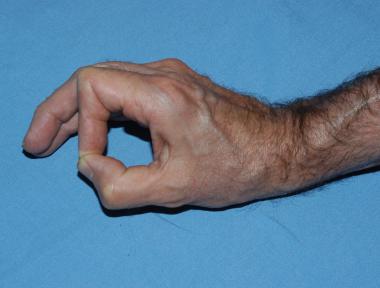 Image in a patient with ulnar neuropathy demonstra