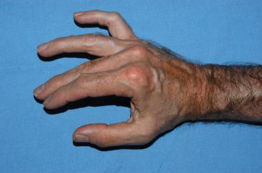 Image in a patient with a partial ulnar nerve para