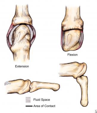 The metacarpal head is uniquely shaped in that it 