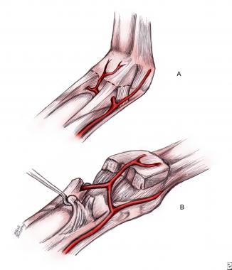 With injury, checkreins form at the IP joints. Che