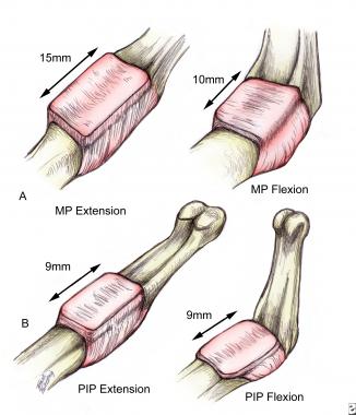 Edema is the initial response to any insult to the