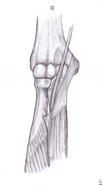 Fibrous arch of flexor digitorum superficialis. 