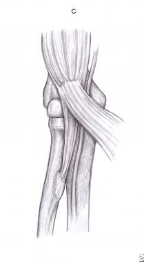 Lacertus fibrosus (bicipital aponeurosis). 