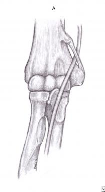 Ligament of Struthers. 