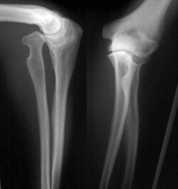 Congenital radial head dislocation. 