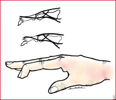 Mallet finger due to loss of central extensor tend