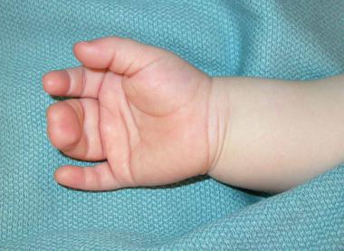 Palmar view of the hand of a 1-year-old child with